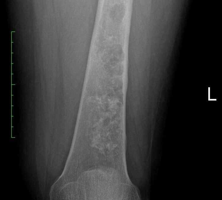 Conventional Chondrosarcoma