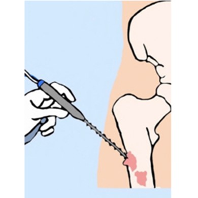 Radiofrequency Ablation