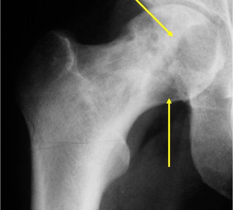 Clear Cell Chondrosarcoma