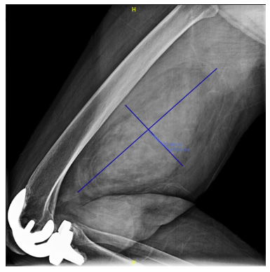 Dedifferentiated Liposarcoma