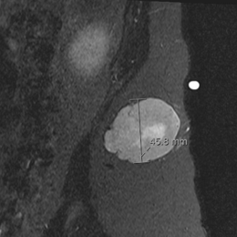 Dermatofibrosarcoma Protuberans