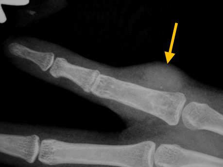 Giant Cell Tumor of Tendon Sheath