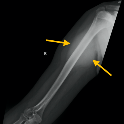 Malignant Peripheral Nerve Sheath Tumor