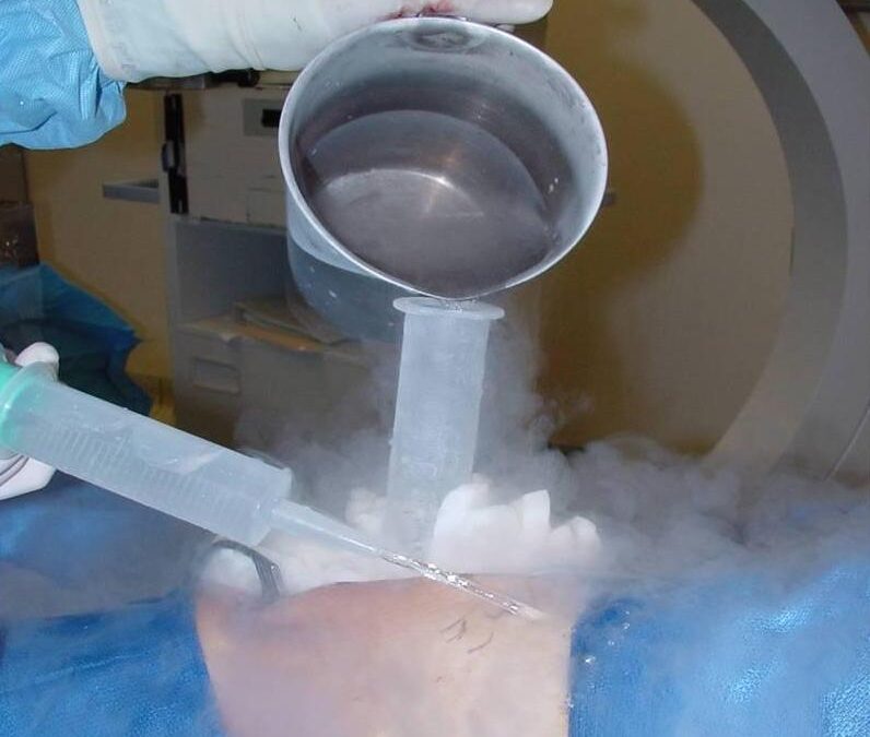Cryosurgery