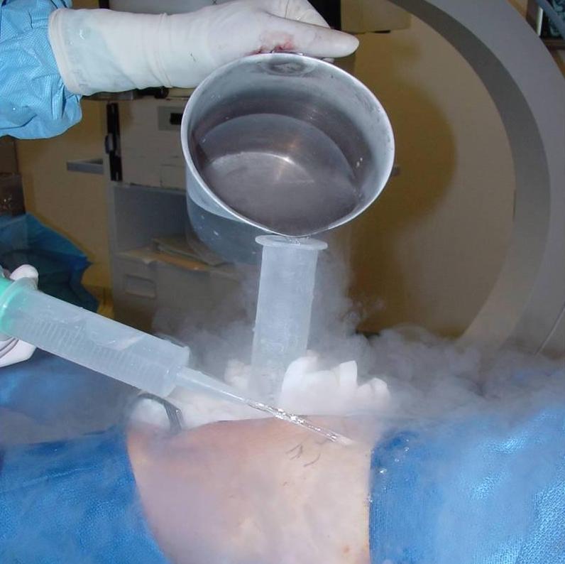 Cryosurgery