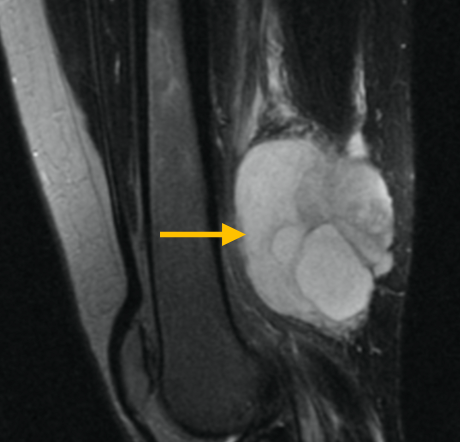 Pleomorphic Liposarcoma