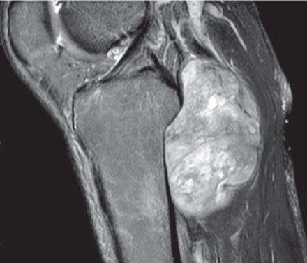 Popliteal Fossa Excision (Back of Knee)