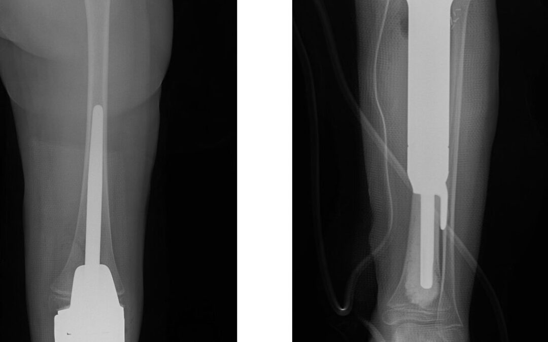 Limb-Sparing Surgery of the Proximal Tibia