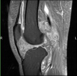 Pigmented Villonodular Synovitis (PVNS)