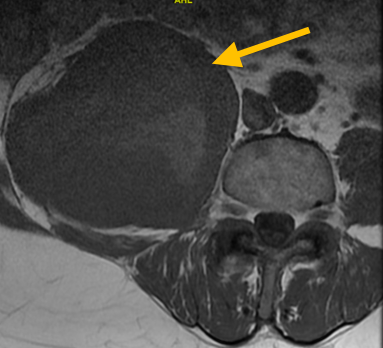 Undifferentiated Pleomorphic Sarcoma of Soft-Tissue