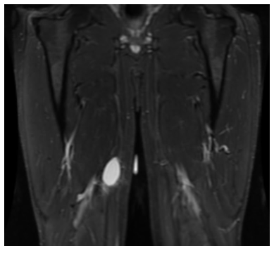 Round Cell Liposarcoma