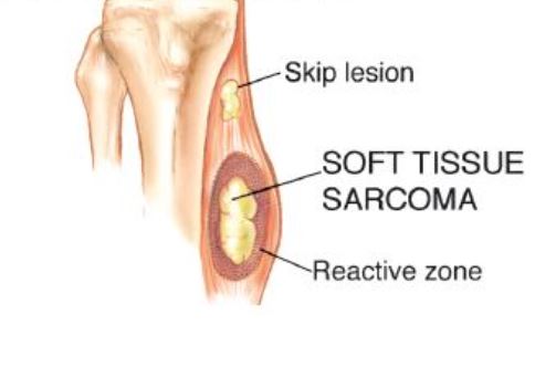 Excision of Benign Soft Tissue Tumors
